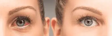 Alpha lipoic acid for eyes