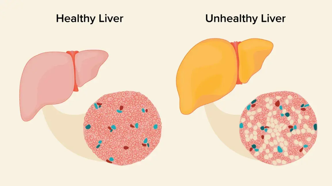 Ursodeoxycholic Acid For Fatty Liver
