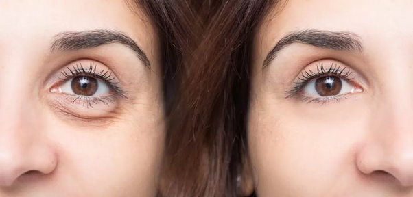 Vitamin K for dark circles