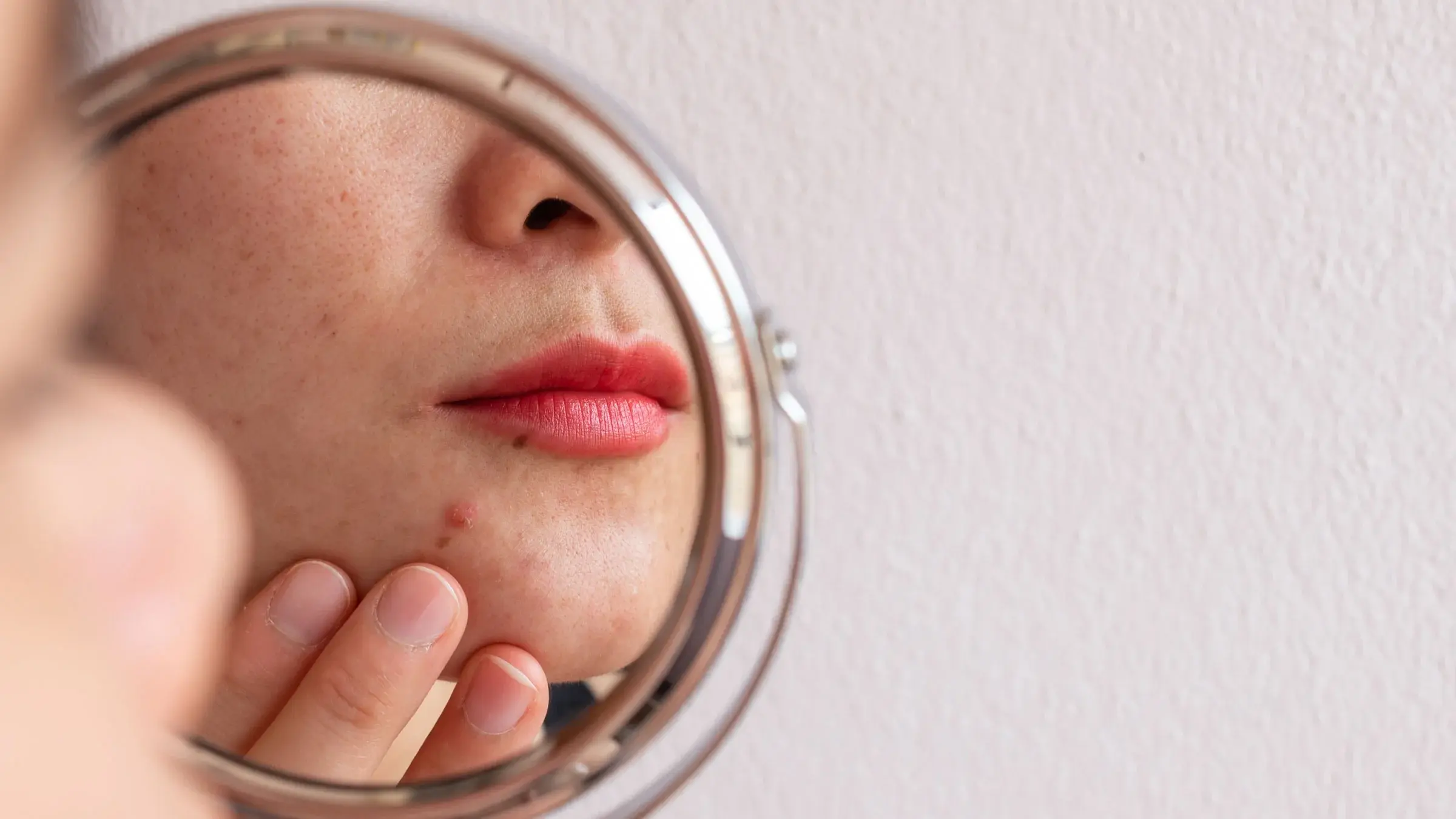 Vitamin B6 Powder Help With Acne Treatment