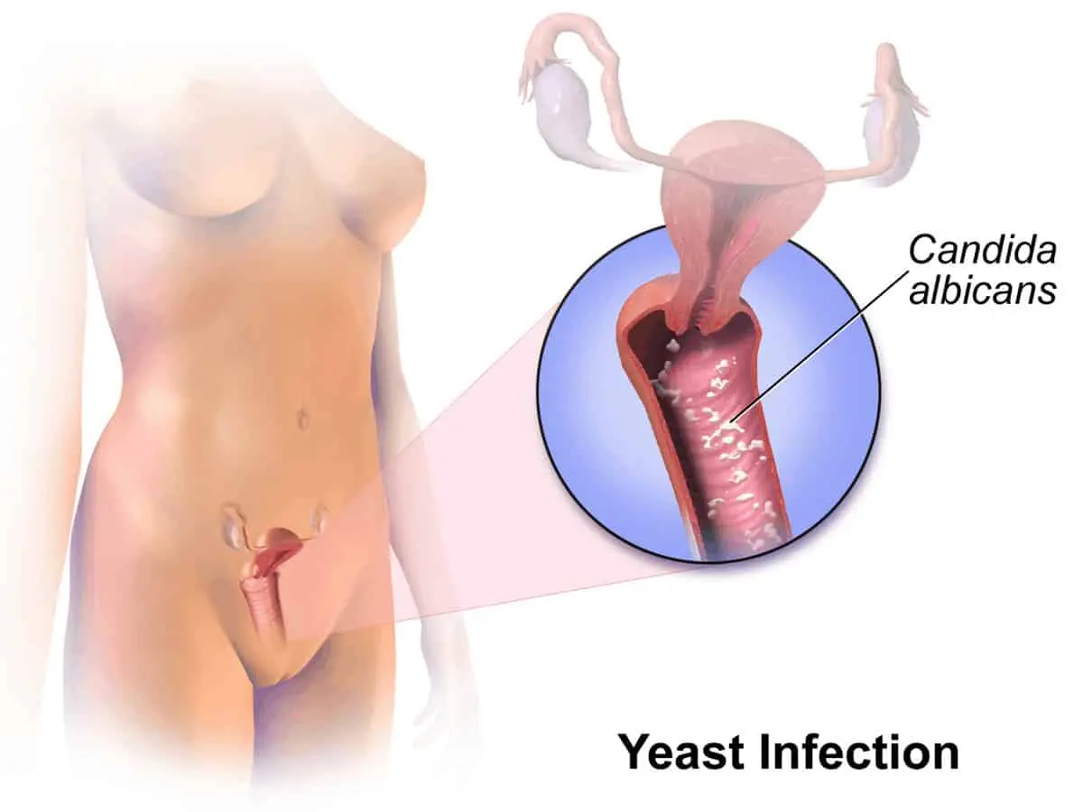 Can Selenium Yeast Cause Yeast Infections? Can Selenium Yeast Cause Yeast Infections?