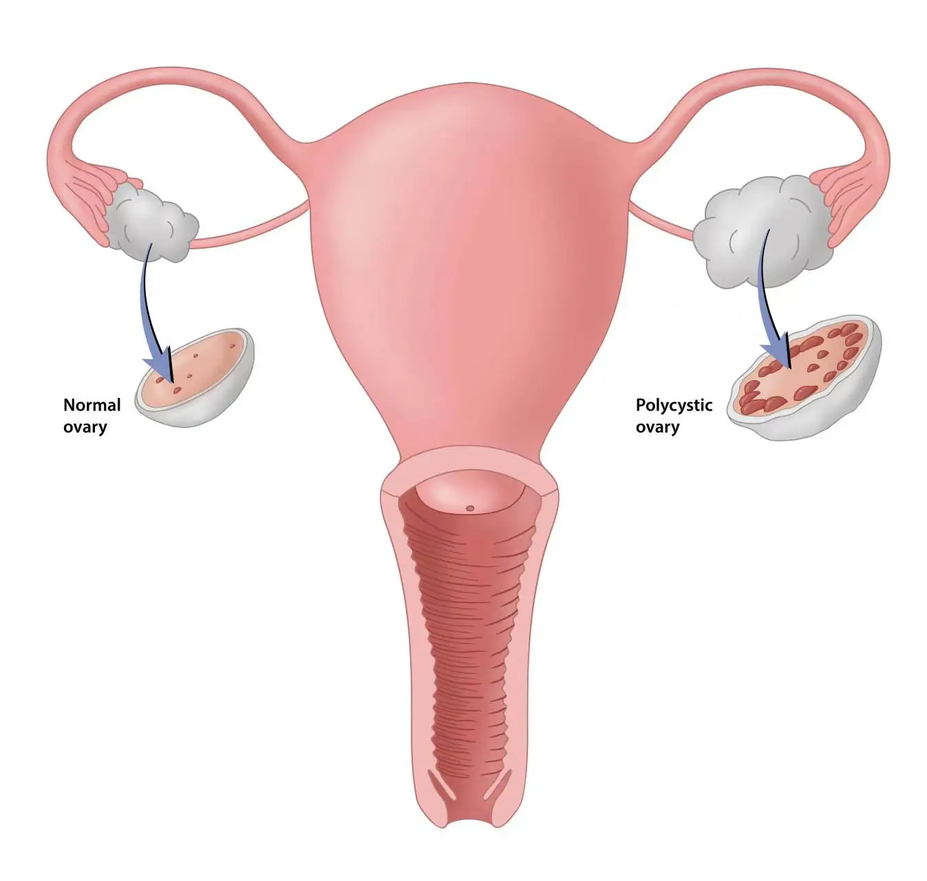  Inositol for PCOS