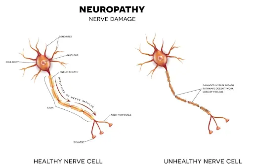Benfotiamine Neuropathy